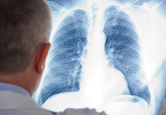Tuberculose no Brasil: mortes no maior nível em 26 anos