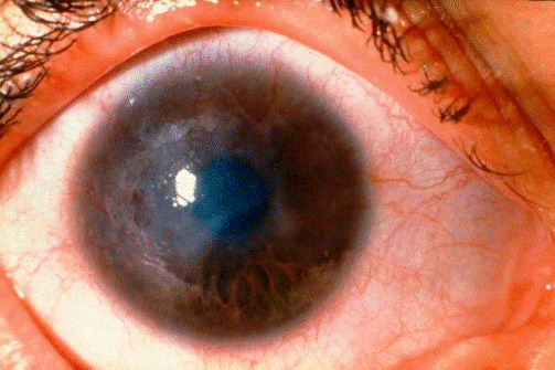 Tracoma: a doença que cega em silêncio  e o Brasil não sabe dizer quantas pessoas ainda têm